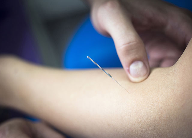capital physiotherapy dry needling service image