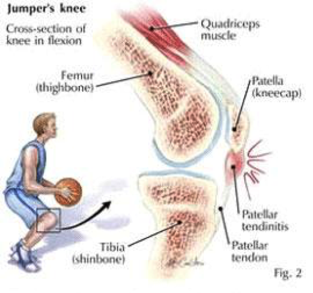 Patella Tendinopathy Capital Physiotherapy