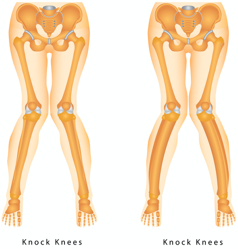 Best 4 Ways to Fix Knock Knees - Capital Physiotherapy