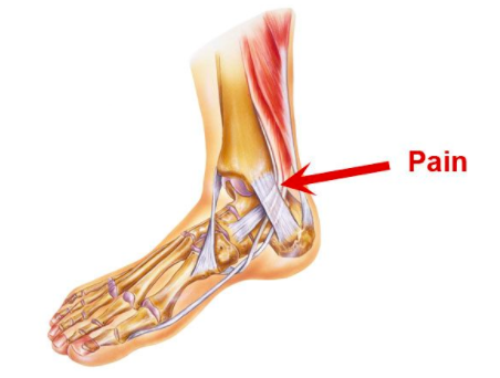 Inner Ankle Pain Running |