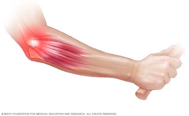 tennis-elbow-pain-diagram
